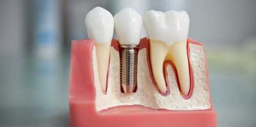 выравнивание зубов взрослому и ребенку: выбор подходящего метода